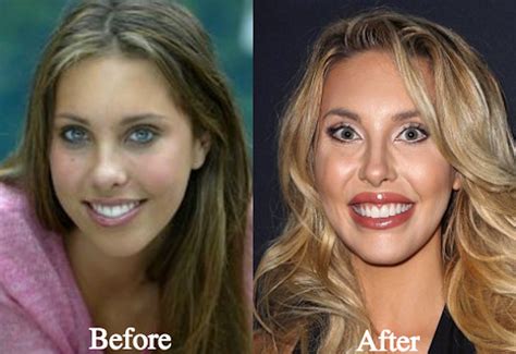 chloe lattanzi botox|chloe lattanzi before surgery.